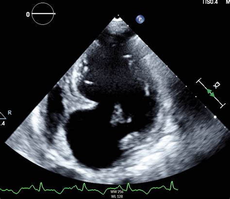 lv aneurysm vs pseudoaneurysm|pseudoaneurysm vs true aneurysm echo.